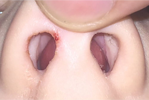 Nasal haematoma_smaller